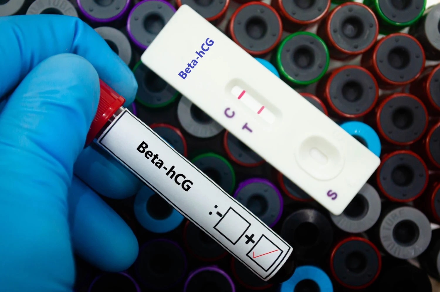 Close-up of a gloved hand holding a blood sample tube labelled beta-hCG, alongside a positive beta-hCG pregnancy test strip, used to confirm pregnancy after IVF treatment.