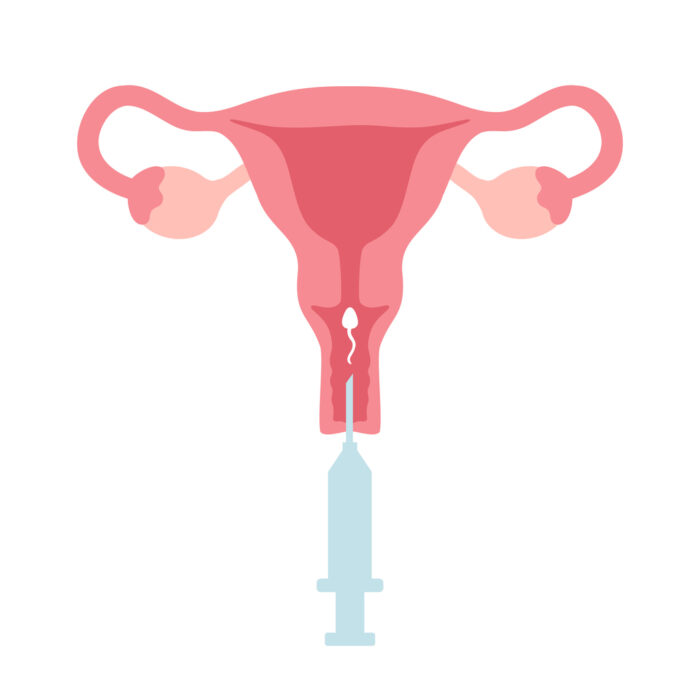 Illustration médicale de l’insémination intra-utérine (IIU), montrant l’introduction de spermatozoïdes dans l’utérus à l’aide d’une seringue et d’un cathéter.