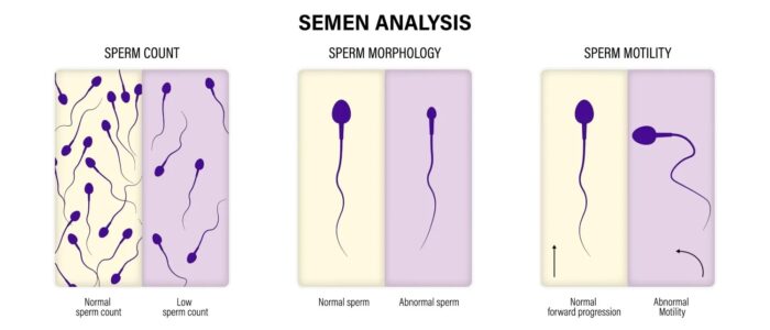 Illustration montrant la numération, la morphologie et la motilité des spermatozoïdes, avec les différences entre paramètres normaux et anormaux dans l’évaluation de la fertilité.